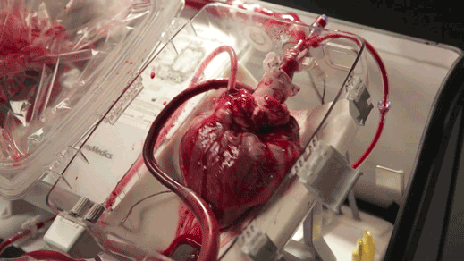 Heart_transplant_boxx519