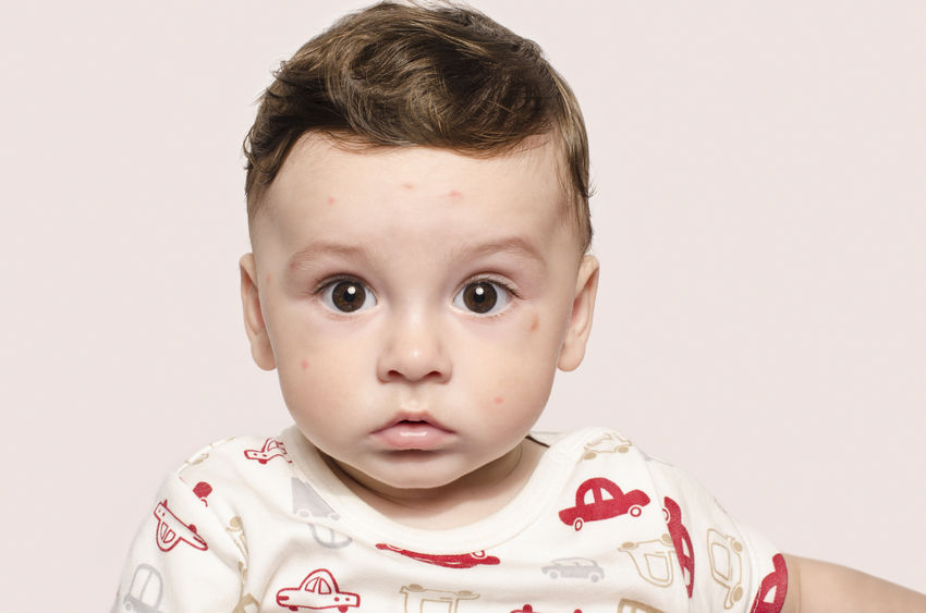 69217180 - portrait of a cute sick baby boy looking surprised at the camera. adorable child with spots on his face form illness, mosquito bites, roseola, rubella, measles.