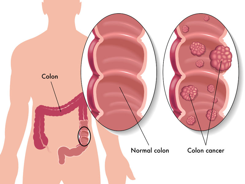 27490934 - colon cancer