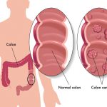 27490934 – colon cancer